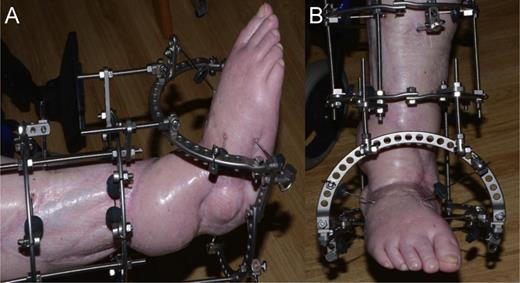 External fixation used to facilitate tibiocalcaneal arthrodesis post talectomy. (A) Lateral view (B) Anterior posterior view.