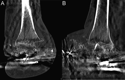 Computed tomography scans illustrating tibiocalcaneal fusion 1 year postoperatively. (A) Anterior–posterior view; (B) Lateral view.