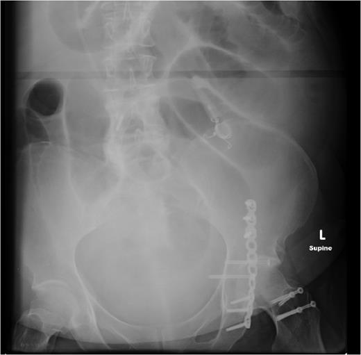SBO established on plain abdominal radiograph, with gastric band tubing and port also evident.