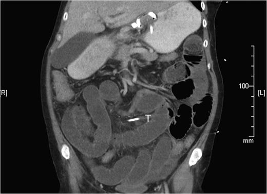 Computed tomography reconstruction showing the SBO with transition zone in the mid ileum, later discovered to be caused by gastric band tubing (T).