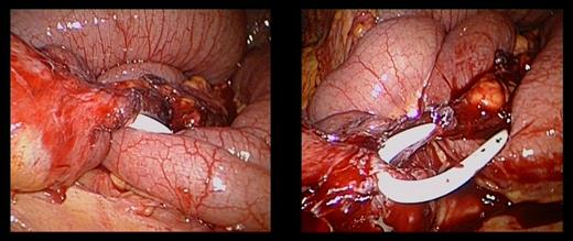 The gastric band connection tube had formed a dense adhesion to the jejunum resulting in a tight obstructive band.
