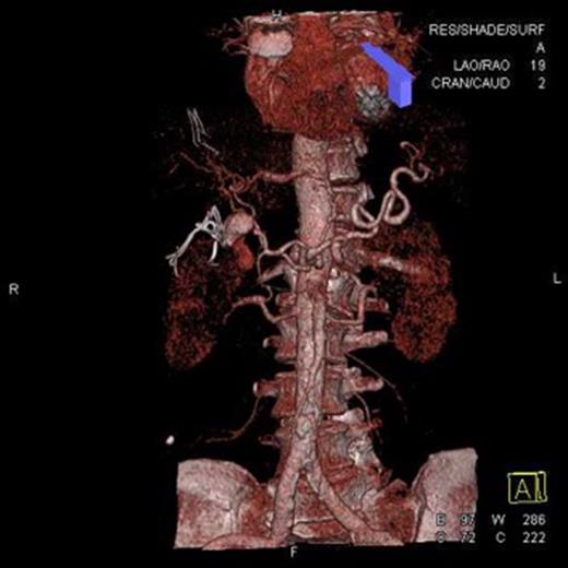 Computed tomographic angiogram. Three-dimentional reconstruction of hepatic vascular tree showing a 30-mm saccular aneurysm of the hepatic artery.