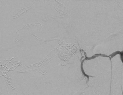 Post coil embolization arteriogram with 5-minute delay showing coils inside aneurysm and no extravasation of contrast into aneurysmal sac.