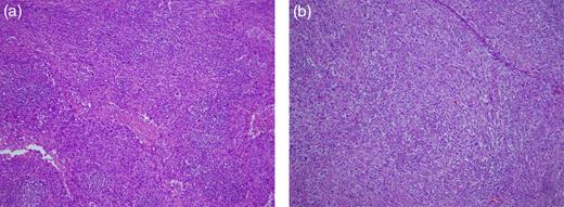 (a) Cervical lymph nodes. The specimen shows poorly differentiated SCC (H&E stain, ×40). (b) Metastatic colorectal tumor. The specimen shows poorly differentiated SCC similar to that seen in the cervical lymph nodes (H&E stain, ×40).