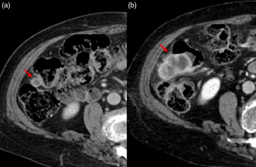 A preoperative CT scan showed a small lesion with contrast effect in the transverse colon, which was difficult to distinguish from inflammation (a). Three months after operation, it was noted that the colonic lesion had grown considerably (b).