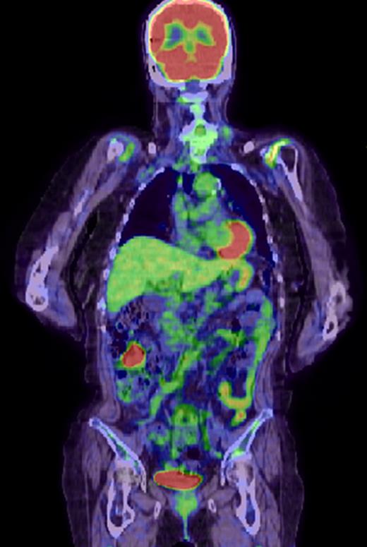Fluorine-18 fluorodeoxyglucose positron emission tomographic scan shows positive findings in the transverse colon, with no other positive lesions.