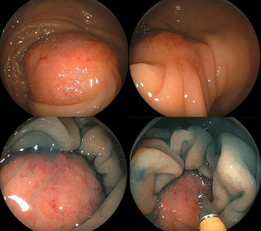 Colonoscopy reveals a 40-mm submucosal tumor with an inflamed surface in the transverse colon. Chromoendoscopy shows a tumor covered with normal mucosa. This lesion was a solid mass with a negative cushion sign (pressure applied to the tumor with a closed pair of biopsy forceps).