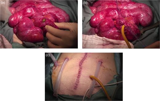 (a) Perforation on the edematous and damaged small intestine wall. (b) A rubber T-tube was inserted through the perforation and tightened in place with several stitches. (c) The T-tube was brought out through the abdominal wall, and the bowel was sutured to the abdominal wall at the exit site.
