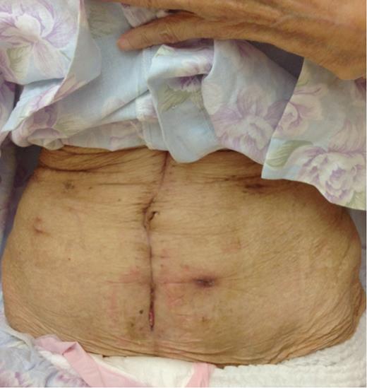 The fistula closed spontaneously within 2 days.