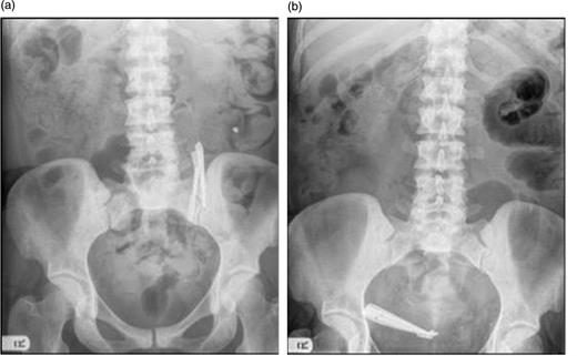 (a) Foreign bodies remain static in the small intestine on follow-up. (b) Foreign bodies seen to have moved to overlie the right iliac fossa.