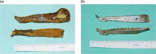 (a) Foreign bodies following removal from small bowel (note faecolith). (b) Foreign bodies after faecolith removal.