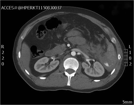 Axial view of the initial CT scan showing Grade IV splenic injury with contrast pooling in the peritoneal cavity.