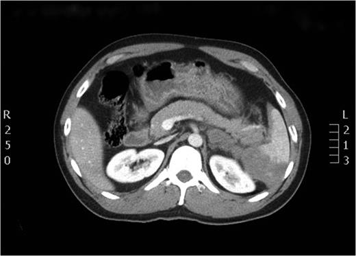 Axial view of the initial CT scan depicting a normally perfused pancreatic tissue.