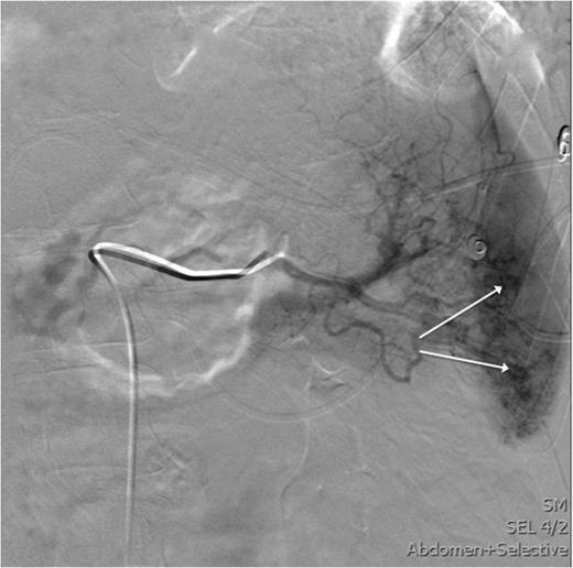 This image shows an angiography of the splenic artery observing splenic contrast leak (white arrows).