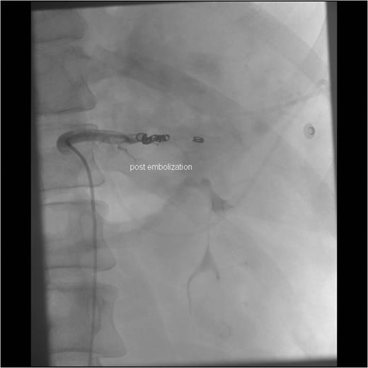 Angiographic imaging post-embolization observing four proximal coils in the splenic artery 3–4 cm distal to the celiac trunk.
