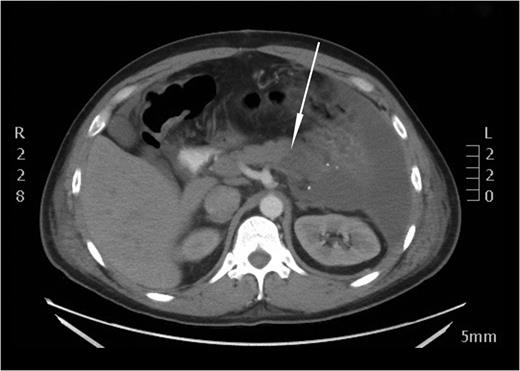 An axial CT image performed on the next day after embolization. A distinct perfusion discrepancy between a normally perfused body and a non-perfused tail of the pancreas is noted (white arrow).
