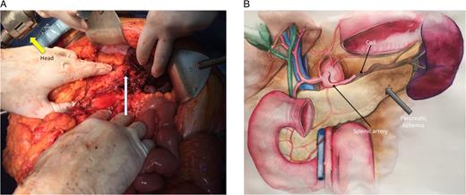 (A) The photo shows the intraoperative finding with distal pancreatic ischemia (white arrow). (B) The same intraoperative finding depicted on the illustration. Most of the stomach is removed on the illustration (illustration by Getter Laur).