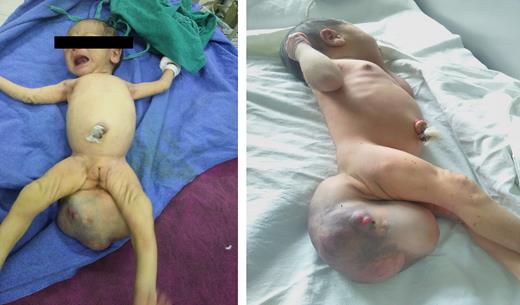 Gross swelling in sacrococcygeal region occupying bilateral buttock and intergluteal area.