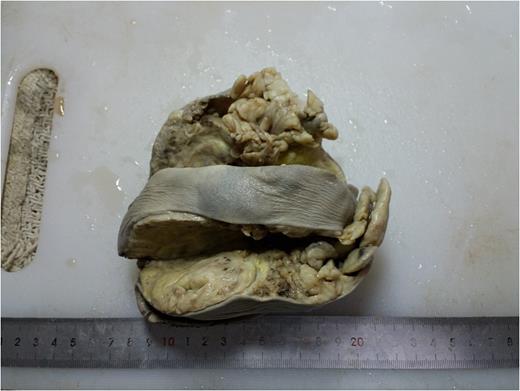 Cut section of the mass showing nodular, solid gray white tissue with yellowish areas and fibrofatty tissue.