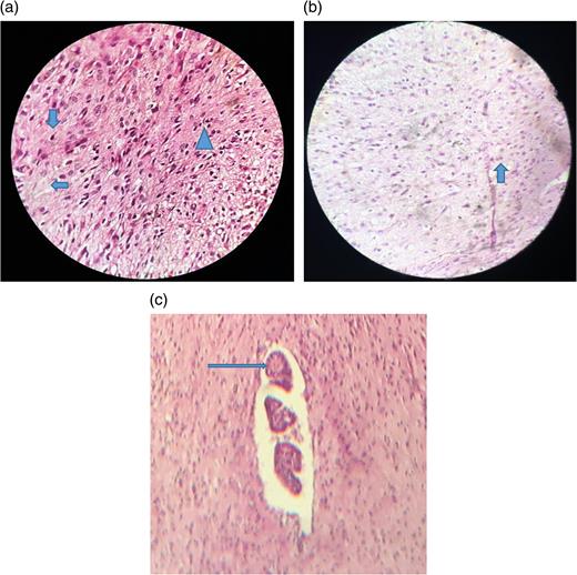 (a) Areas showing oligodendrocytes = , astrocytes = and fibrillary background = ; (b) Areas showing gemistocyte; (c) Picture showing choroid plexus with papillary projection lined by columnar epithelium.