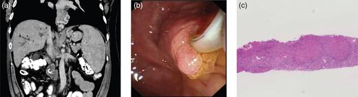 (a) Preoperative CT scan revealed significant portal hypertension with large para-esophageal varices and splenomegaly. (b) ERCP image demonstrating the ampullary adenoma. (c) Liver biopsy reveals features in keeping with CHF.