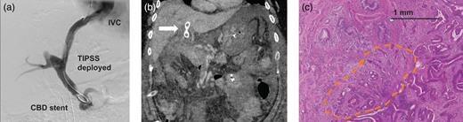 (a) Successful TIPPS deployment following insertion of a partially covered metallic biliary stent enabled portal decompression and resection to be performed. (b) Postoperative CT scan revealed failure of the TIPS (arrow) along with SMV thrombus resulting in significant venous congestion of the small bowel. (c) Histological examination of the resected specimen revealed a small cholangiocarcinoma.