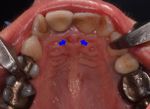 Preoperative clinical situation: occlusal view of the maxillary arch presenting two small depressions of the mucosa on either side of the incisive papilla (blue arrows).
