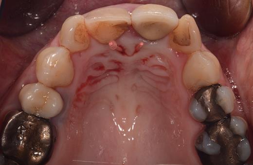 Occlusal view of the maxillary arch presenting two small openings of the mucosa with two inserted gutta-percha points on either side of the incisive papilla.