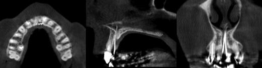 Gutta-percha points in the two NPDs showing communication between the oral and nasal cavities (cone beam CT: axial, sagittal and coronal sections).
