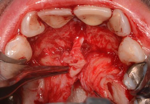 Preparation of the soft tissue of the incisive canal and the incisive papilla.
