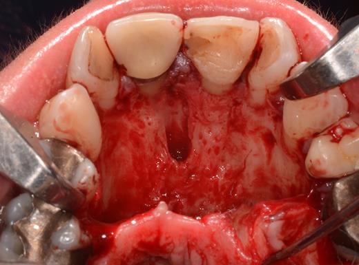 Situation after removal of the entire soft tissue contents of the incisive canal.