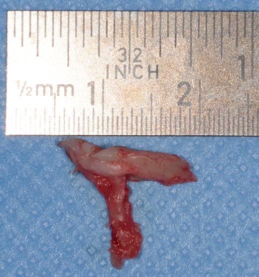 Excised soft tissue contents of the incisive canal including the neurovascular bundle and the incisive papilla.