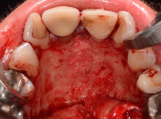 Filling of the incisive canal using autologous bone harvested from the palatal region.