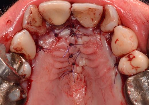 Occlusal view after tension-free primary wound closure.