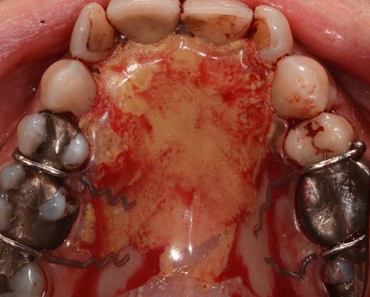 Coverage of the anterior palate with an iodoform gauze and a palatal plate.