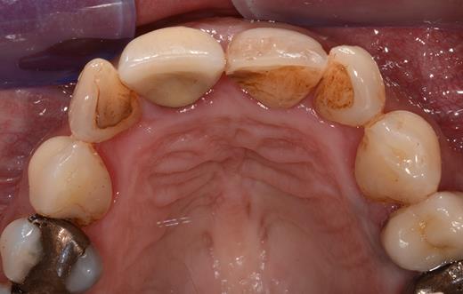 Site of initial manifestation of the patent NPD after 6 months with healthy mucosa and absence of orifices in the region of the anterior palatal mucosa.