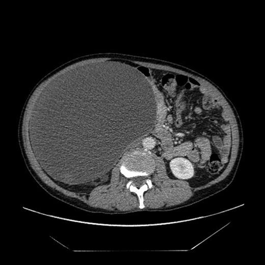 Axial slice from the CT imaging identifying the retroperitoneal pseudocyst.