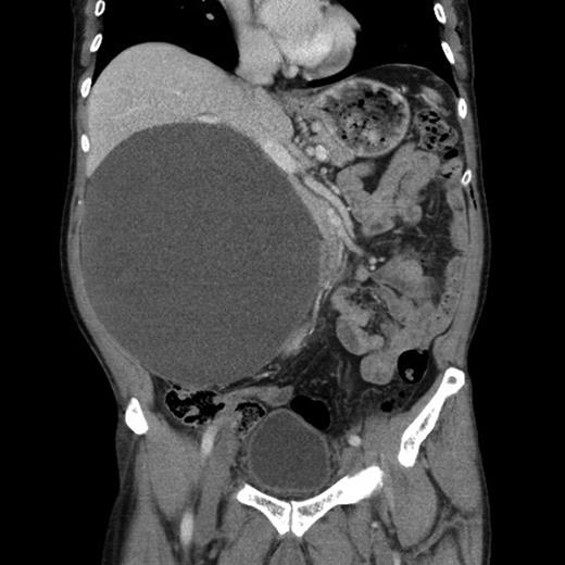 Coronal section of the retroperitoneal pseudocyst.