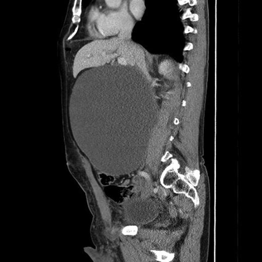 Sagittal view of the retroperitoneal pseudocyst.
