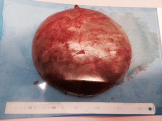 The intact excised pseudocyst.