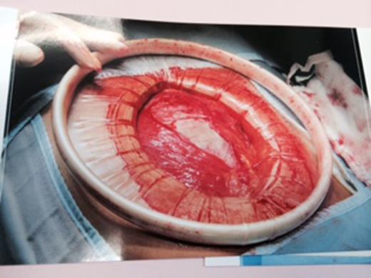 A large Alexis wound retractor was utilized. In the image, centrally, the pseudocyst can be identified prior to retrieval.