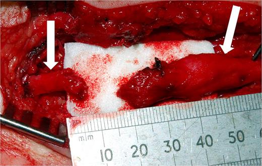 Complete division of the posterior tibial nerve proximal to the bifurcation into the plantar nerves.