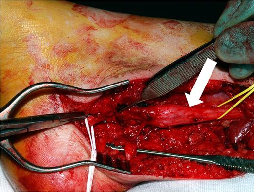 Large neuroma involving the proximal stump.