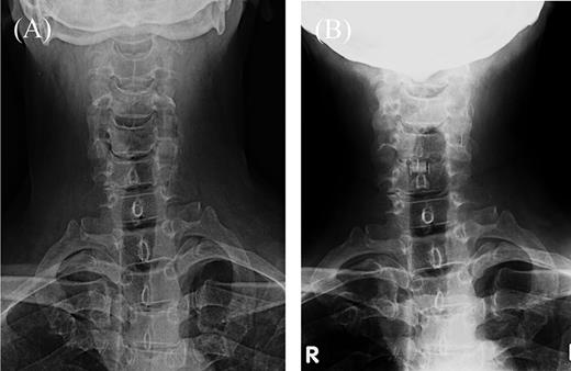 Roentgenograms of C5–6 anterior fusion and scoliosis of the cervicothoracic spine. (A) Cervical frontal view before anterior fusion. (B) Cervical frontal view 5 years after anterior fusion. R: right.