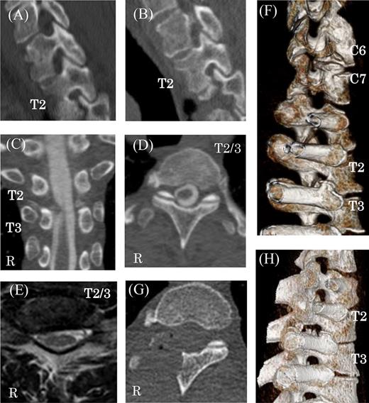 Preoperative and postoperative CT and MR images. (A) Thoracic sagittal views of CT image before cervical anterior fusion at right T2 nerve root canals. Preoperative multi-planar CT images (B–D) and reconstructed 3D images showing right C6–7 and T2–3 nerve root canal stenosis caused by bone spurs of facets and vertebral bodies (F and H). MR imaging of protruded disks at the T2–3 level (E). Postoperative CT shows the decompression of the right T2–3 thoracic nerve root canal (G).