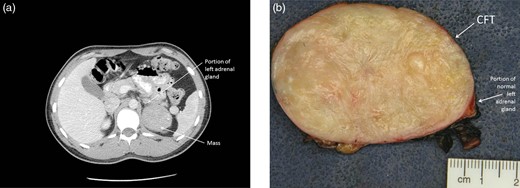 (a) CT scan of the abdomen showing a 6.2 × 5.9 × 4.8 cm retroperitoneal mass appearing to emanate from the lateral limb of the left adrenal gland. (b) Photograph of the gross specimen revealing a firm, white-tan and well-circumscribed tumor. A portion of normal adrenal tissue is visible.