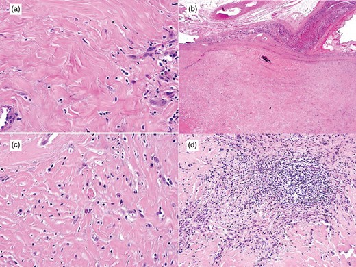 (a,b) CFT demonstrating hypocellular proliferation of bland spindle cells, densely hyalinized collagen, chronic lymphoplasmacytic inflammation and dystrophic calcifications (H&E; x400 and x20). (c,d) Inflammatory component of CFT, comprised small lymphocytes and plasma cells, the latter are occasionally binucleate or have Russell bodies (H&E; x200 and x400).