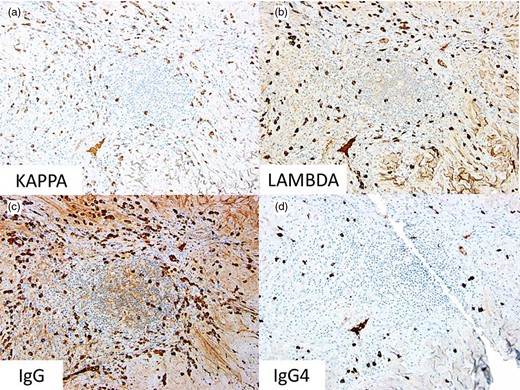 Immunohistochemical stains for (a) kappa light chain expression (x200), (b) lambda light chain expression (x200), (c) IgG (x200) and (d) IgG4 (x200).