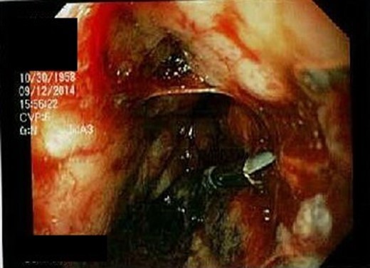 Resolution of hemorrhage following placement of hemostatic clip.