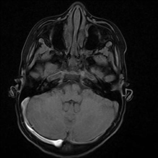 Initial brain MRI at presentation.